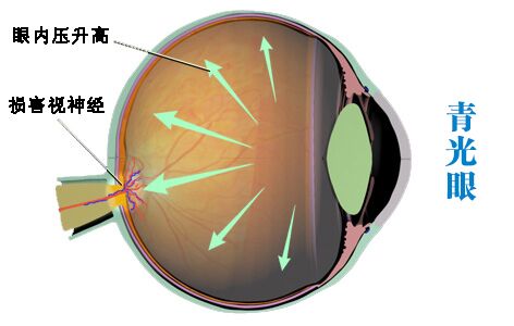 眼壓高的癥狀？ 眼壓高的方法？